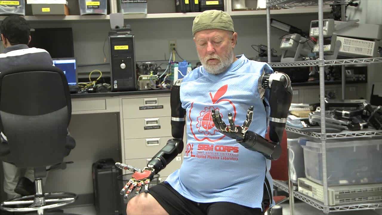 Doppelt armamputierter Mann erhält gedankengesteuerte Roboterarme