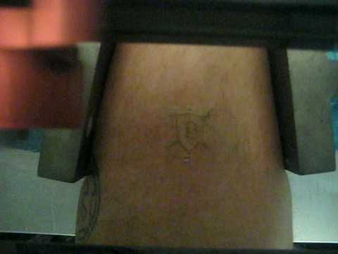 laser tatovering