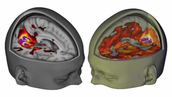 Brain ar LSD san MRI