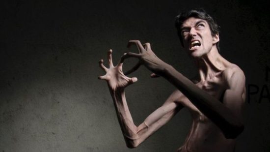 Mann mit seltener genetische Erkrankung ist ein gefragter Darsteller des Grauens