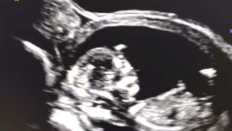 Während der Schwangerschaft geimpft: Wenn man es auf die harte Tour lernen muss