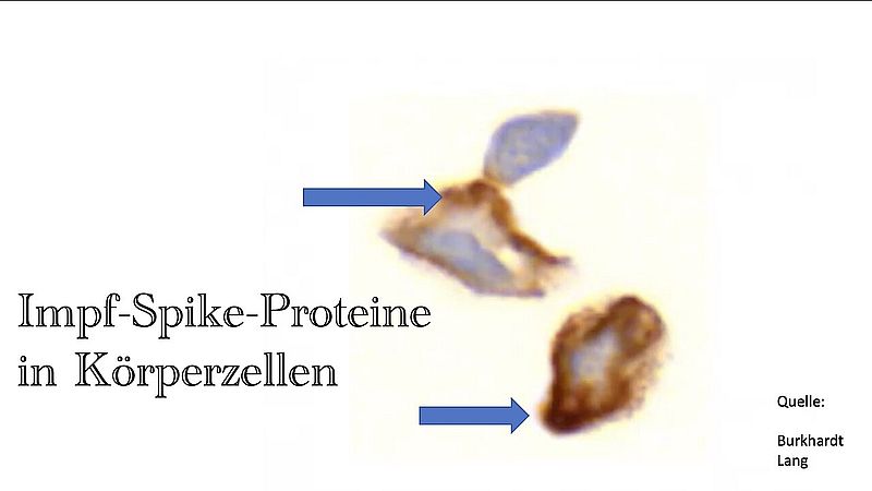 Die impfbedingte Entzündung des Gehirns - Encephalitis