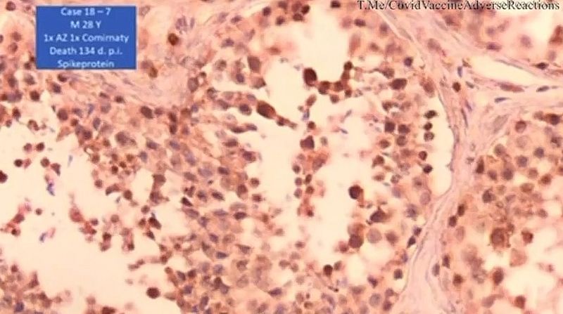 Bei Geimpften sind im Sperma nur noch Spike Protein enthalten