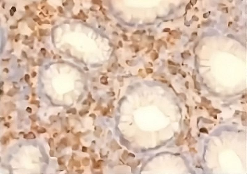 Indovina cosa si trova nelle cellule tumorali?