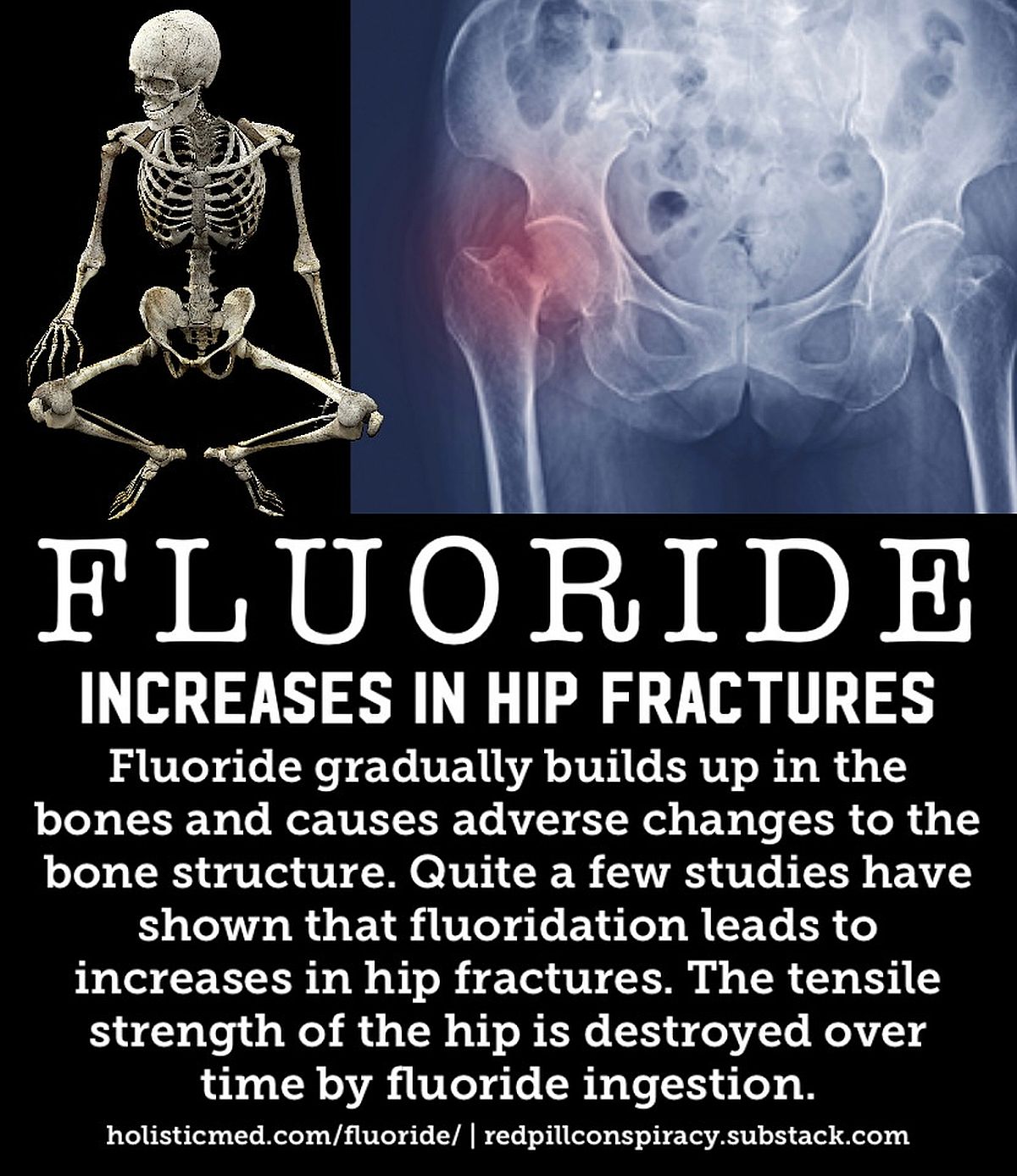 Fluoruro: un producto de desecho industrial que promueve la caries dental