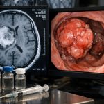 +19,5 % Gehirntumore, +19,4 % Darmkrebs bei unter 50-Jährigen – aber bitte frag nicht warum